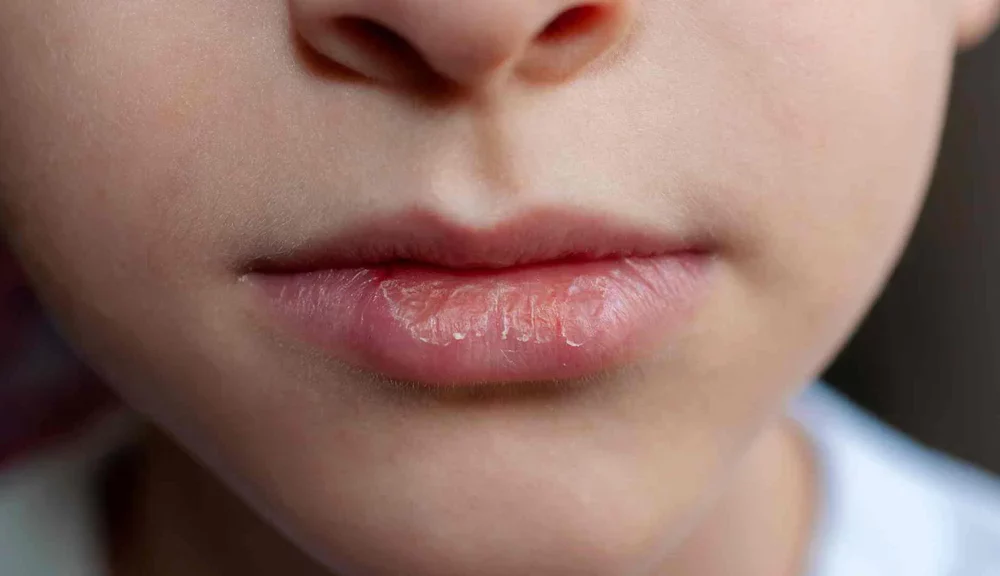 eczema-on-lips-can-be-painful-and-distressing