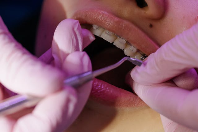 things-to-consider-before-getting-braces